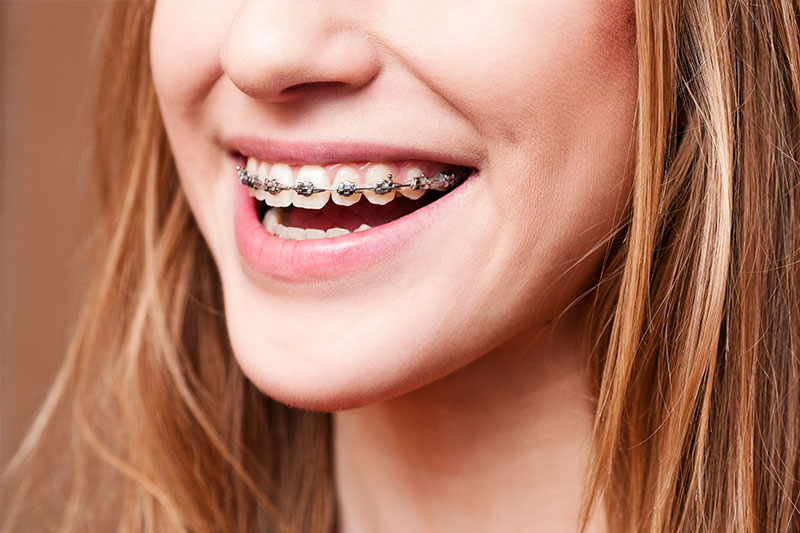 Orthodontics in Wallingford