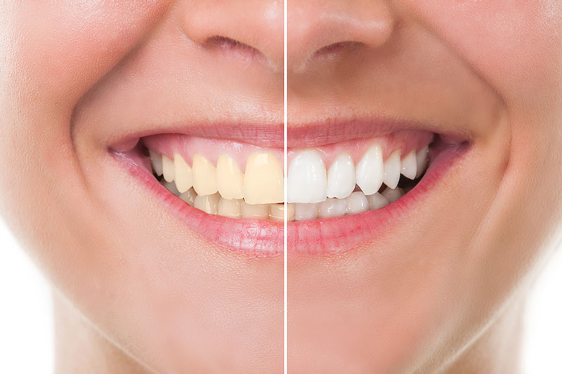 Teeth Whitening in Wallingford